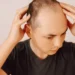 Quais as causas da calvície? Veja por que a queda de cabelo acontece