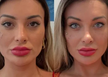 Andressa Urach relata dor após cirurgia para mudar cor dos olhos: ‘Estou arrependida de ter feito’
