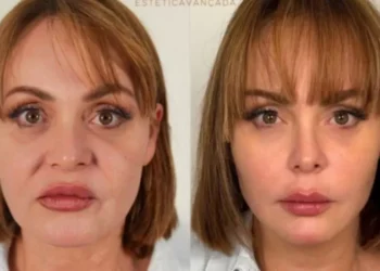 Gaby Spanic, de Usurpadora, surge irreconhecível após harmonização facial